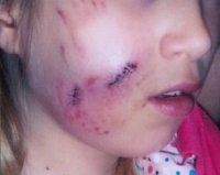foster girl mauled by black Labrador
