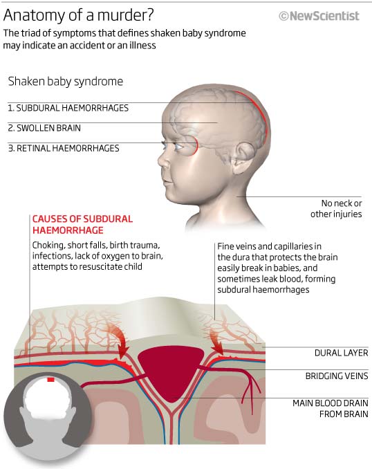 shaken baby markers