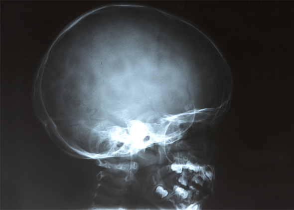 x-ray of child's head