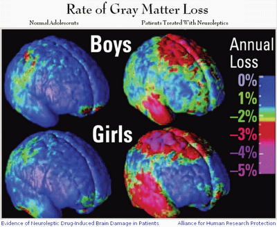 loss of gray matter